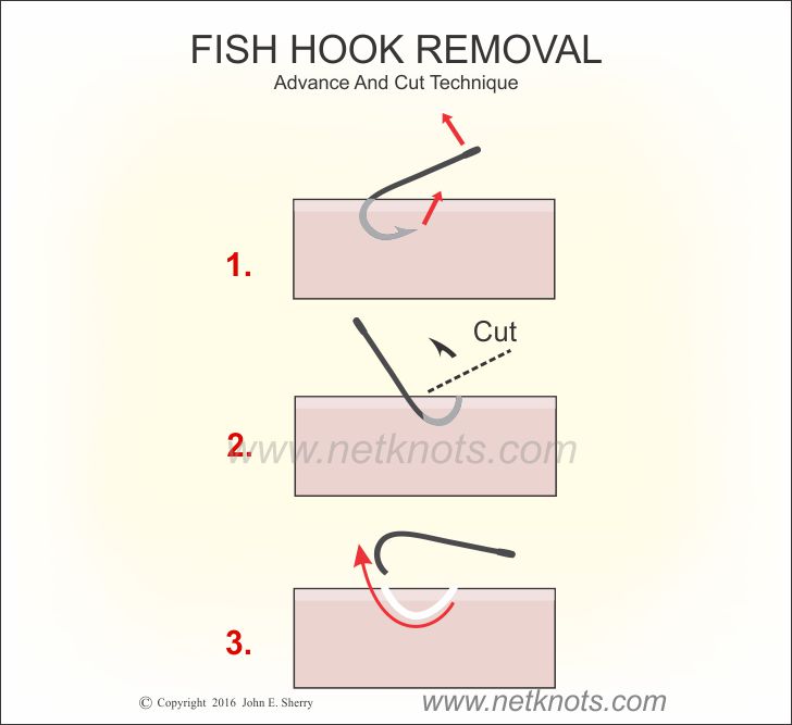 Hook Removal - Advance & Cut